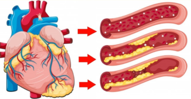 buzzsitemr-HERE-ARE-12-FOODS-THAT-UNCLOG-ARTERIES-NATURALLY